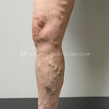 We Offer Top-tier Varicose Vein Treatments