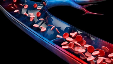 Chronic venous insufficiency