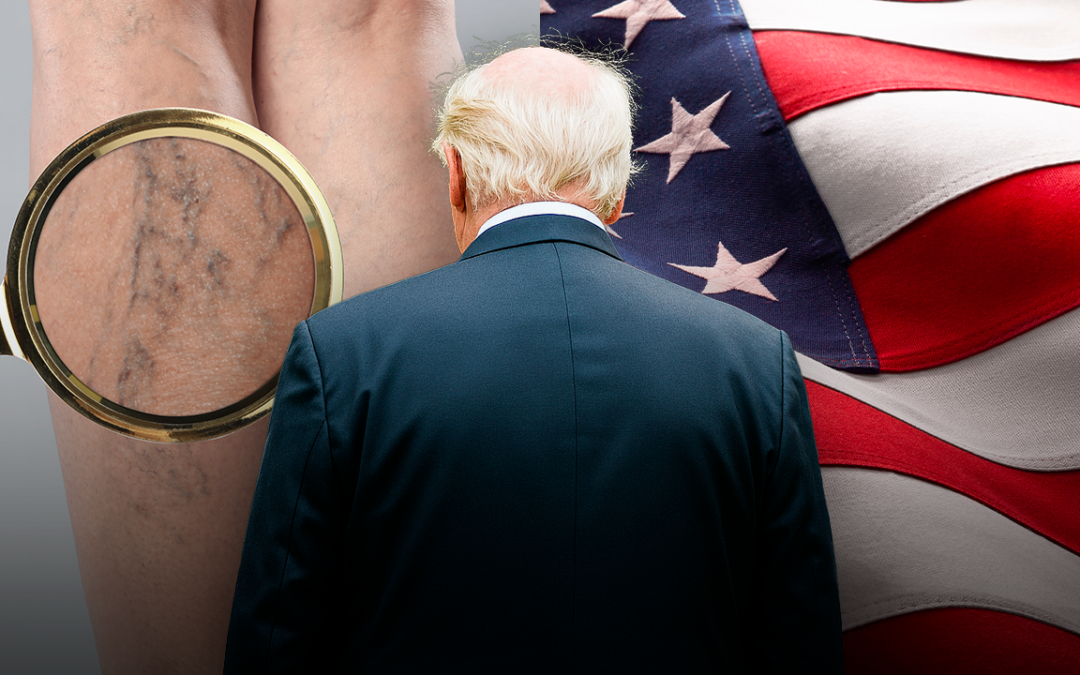 What is chronic venous insufficiency? Trump’s diagnosis explained by vein experts