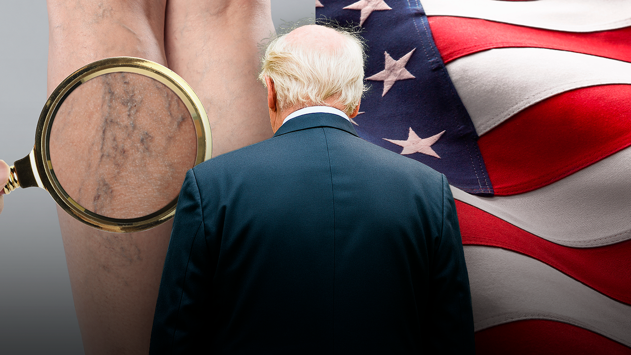 What is chronic venous insufficiency? Trump’s diagnosis explained by vein experts