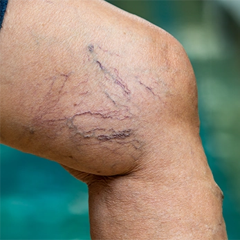 We Offer Top-tier Spider Vein Treatments
