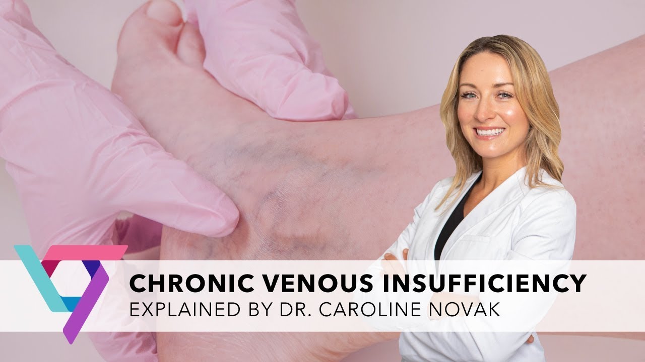 What are the signs and symptoms of venous insufficiency?