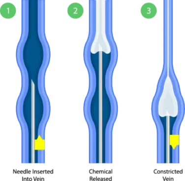 Medical illustration of sclerotherapy, showing a solution injected into a varicose or spider vein to close and treat the vein.