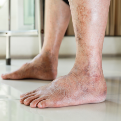 Swollen ankles or calves