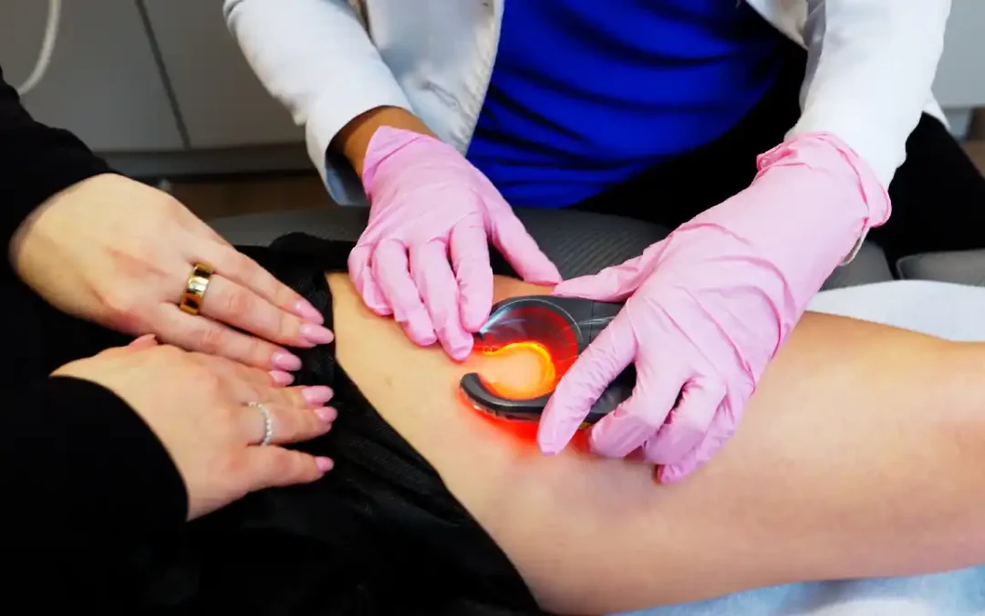 Discover the Best Spider Vein Treatments in Farmington, CT