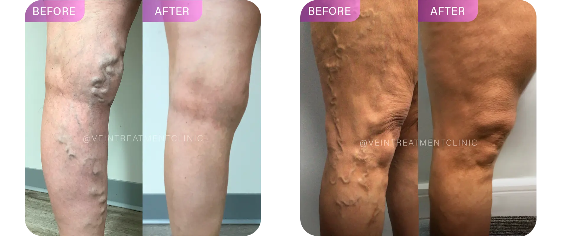 leg before and after our treatments