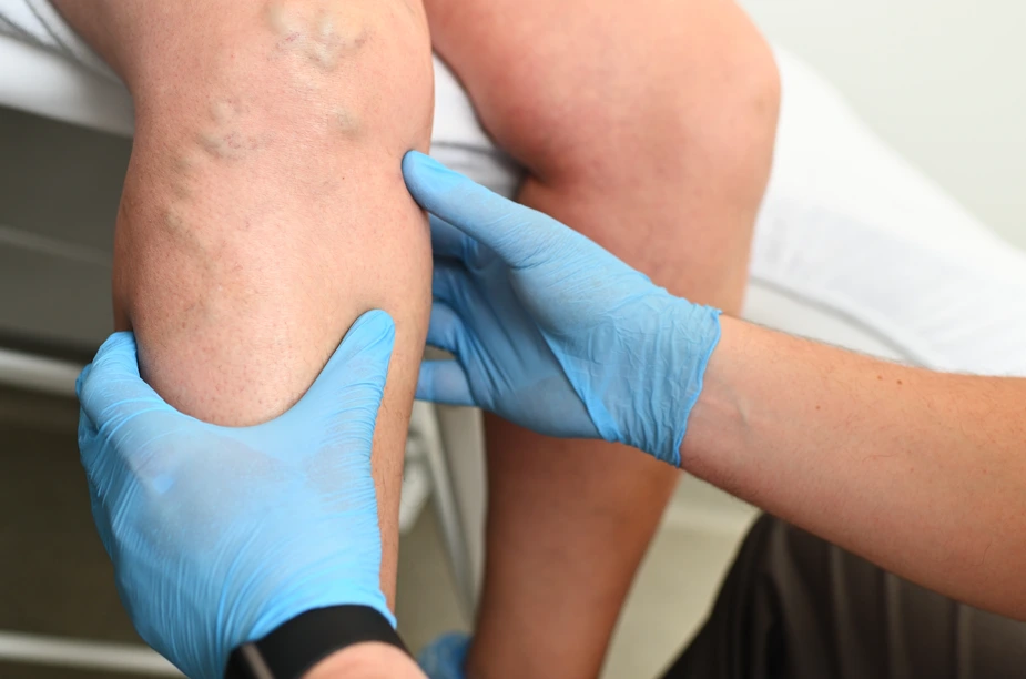 Auto DraftFind Venous Insufficiency Treatment Options in Hamden, CT, With Dr. Martin Tyson