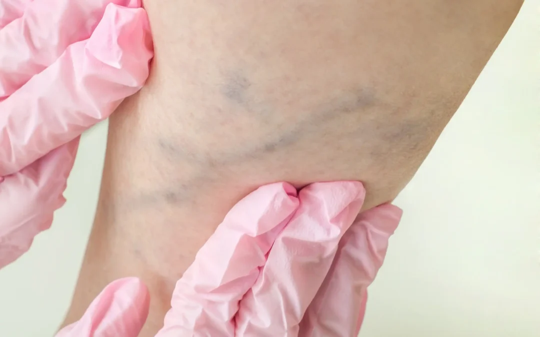 What Is Sclerotherapy and Why Visit a Specialized Vein Clinic?