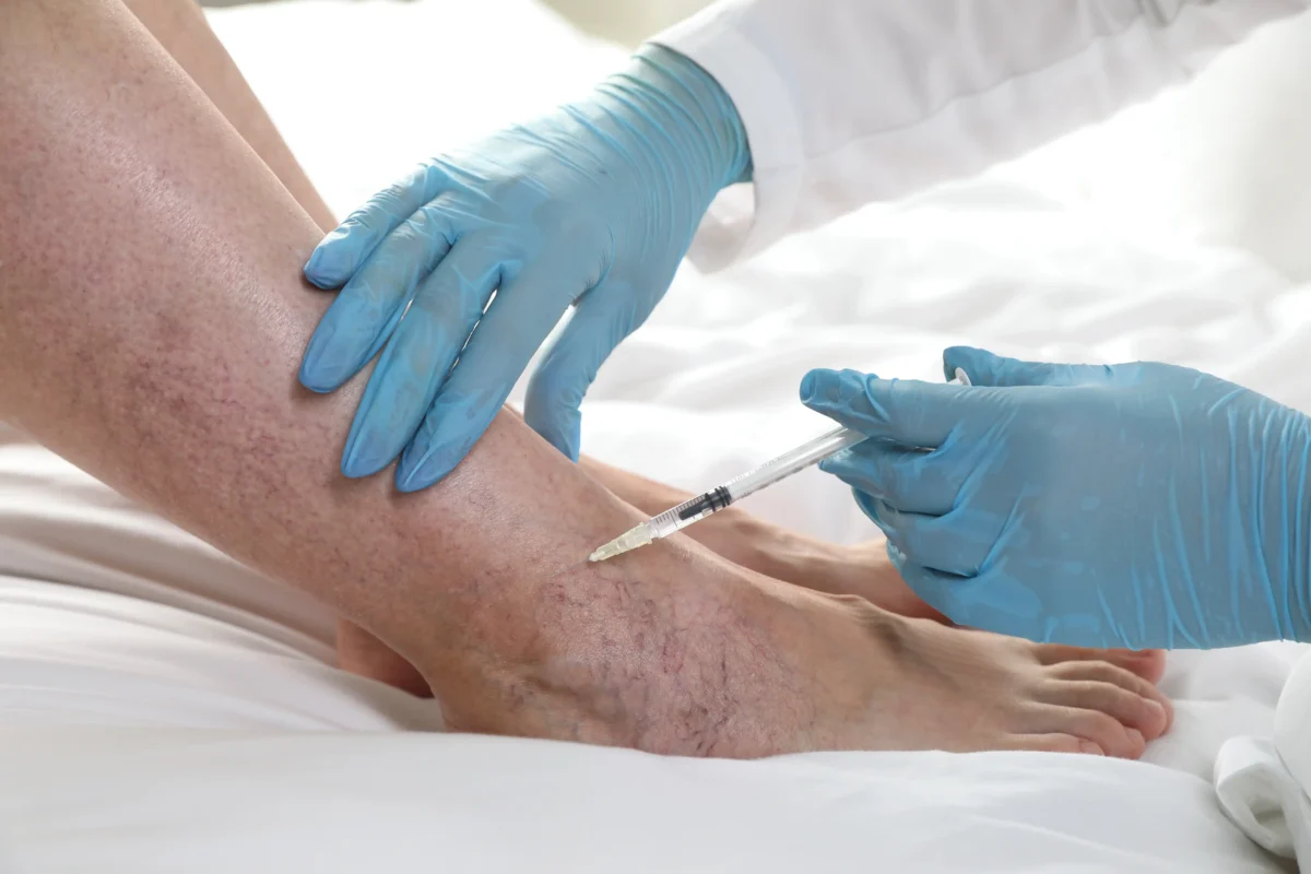 What’s the Fastest Way to Start Vein Treatment?