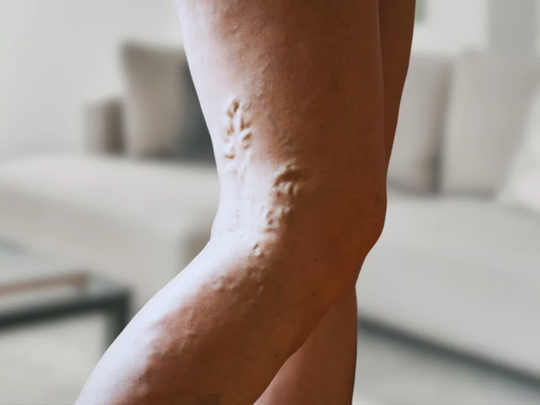 Who is the Best Doctor to Perform Sclerotherapy for Vein Diseases?