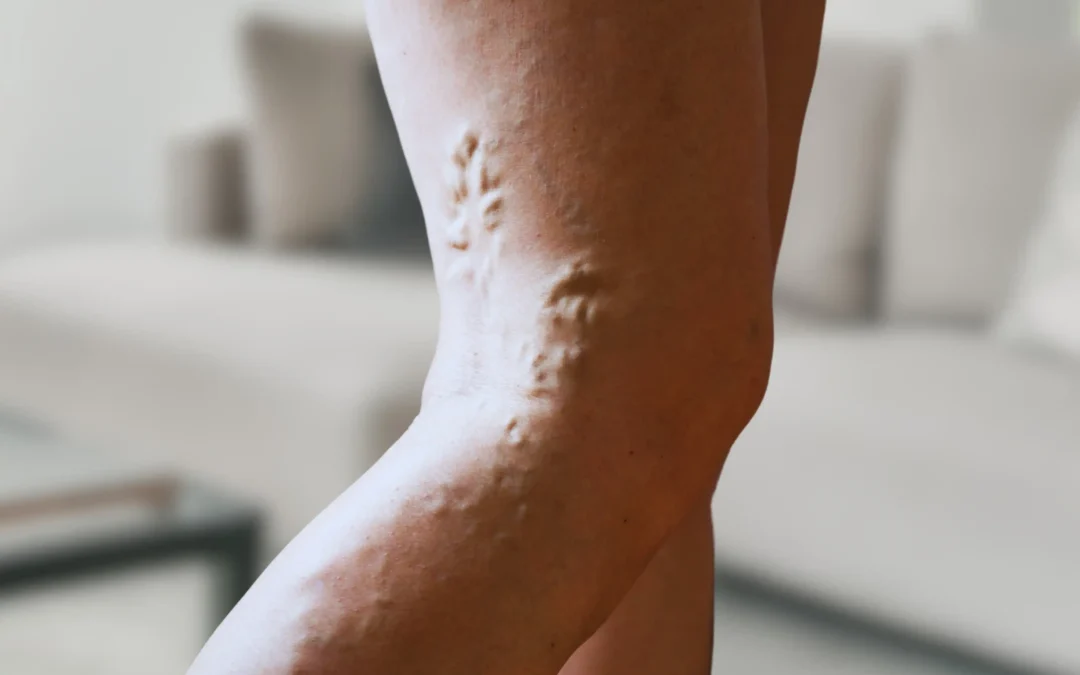 Who is the Best Doctor to Perform Sclerotherapy for Vein Diseases?