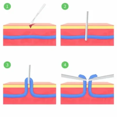Medical illustration of ambulatory phlebectomy, showing how a varicose vein is removed through small skin incisions.