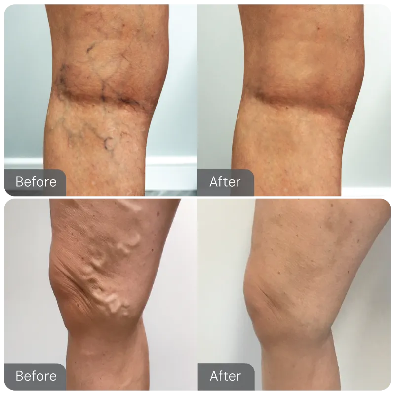 Spider and Varicose vein before and after results from our cutting-edge minimally invasive treatments at the Vein Treatment Clinic