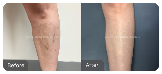 Spider vein before and after results from our cutting-edge minimally invasive treatments at the Vein Treatment Clinic.