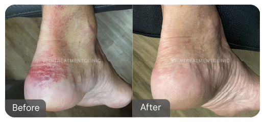 Varicose vein before and after results from our cutting-edge minimally invasive treatments at the Vein Treatment Clinic.