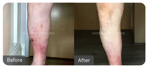 Venous Ulcers before and after results from our cutting-edge minimally invasive treatments at the Vein Treatment Clinic.