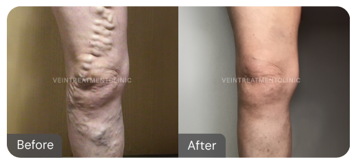 Varicose vein before and after results from our cutting-edge minimally invasive treatments at the Vein Treatment Clinic.