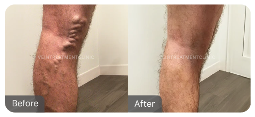 Varicose vein before and after results from our cutting-edge minimally invasive treatments at the Vein Treatment Clinic.