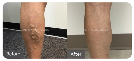 Varicose vein before and after results from our cutting-edge minimally invasive treatments at the Vein Treatment Clinic.