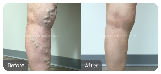 Varicose vein before and after results from our cutting-edge minimally invasive treatments at the Vein Treatment Clinic.