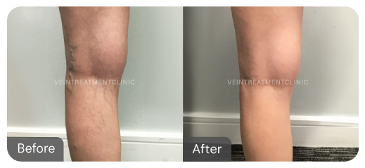 Spider vein before and after results from our cutting-edge minimally invasive treatments at the Vein Treatment Clinic.