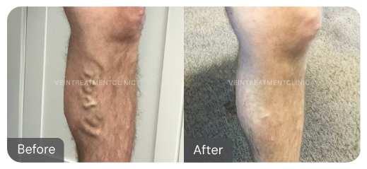 Varicose vein before and after results from our cutting-edge minimally invasive treatments at the Vein Treatment Clinic.