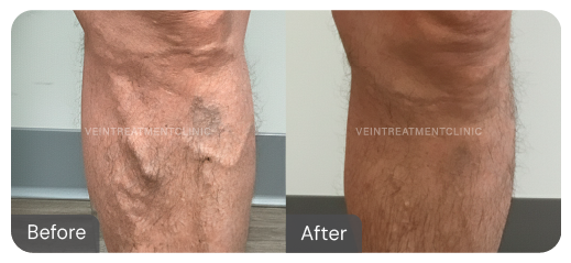 Varicose vein before and after results from our cutting-edge minimally invasive treatments at the Vein Treatment Clinic.