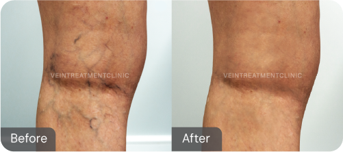 Spider vein before and after results from our cutting-edge minimally invasive treatments at the Vein Treatment Clinic.