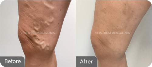 Varicose vein before and after results from our cutting-edge minimally invasive treatments at the Vein Treatment Clinic.