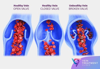 Medical illustration comparing a healthy vein with open and closed valves versus an unhealthy vein with a broken valve leading to blood pooling