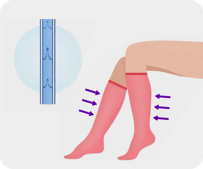 Illustration showing the effects of compression therapy to treat vein diseases after procedures.