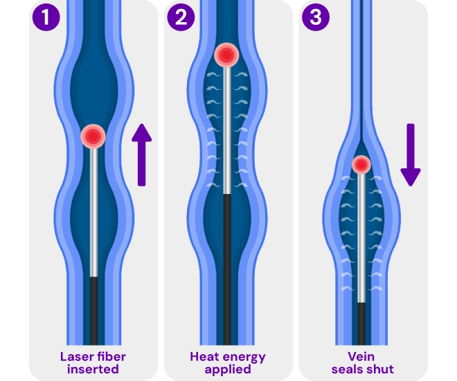 Medical illustration of endovenous laser treatment (EVLT), showing a laser fiber used to heat and close a varicose vein from the inside.