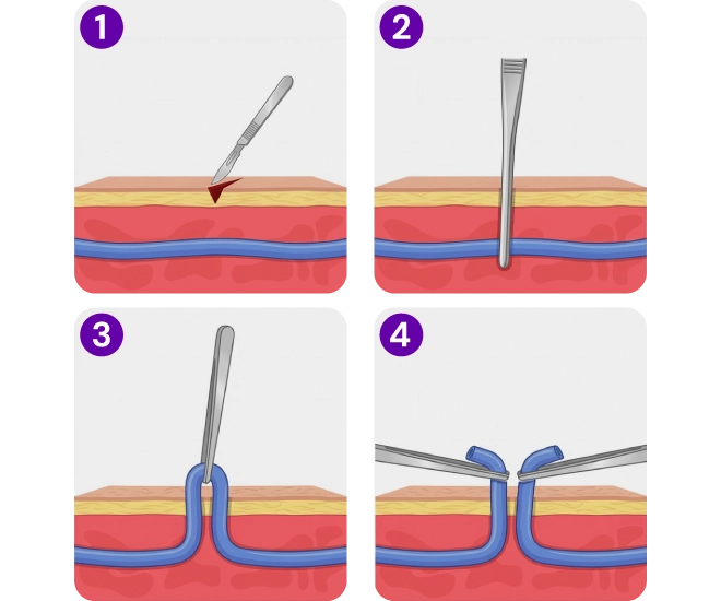Medical illustration of ambulatory phlebectomy, showing how a varicose vein is removed through small skin incisions.
