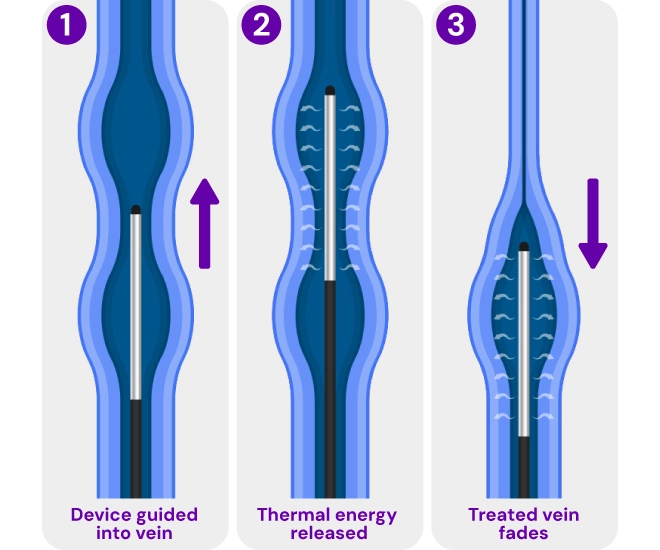 Medical illustration of radiofrequency ablation (RFA), showing a catheter delivering heat to close a diseased vein and restore healthy blood flow.