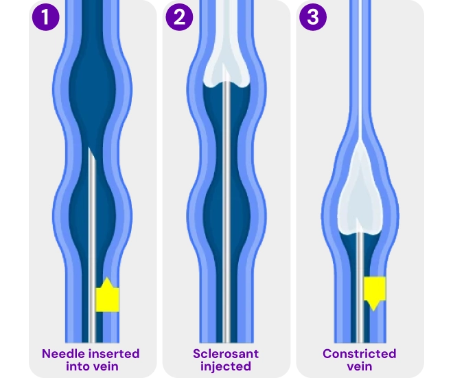 Medical illustration of sclerotherapy, showing a solution injected into a varicose or spider vein to close and treat the vein.
