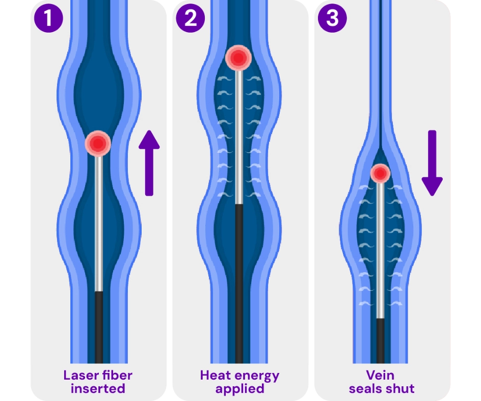 Medical illustration of endovenous laser treatment (EVLT), showing a laser fiber used to heat and close a varicose vein from the inside.