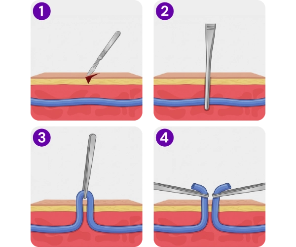 Medical illustration of ambulatory phlebectomy, showing how a varicose vein is removed through small skin incisions.