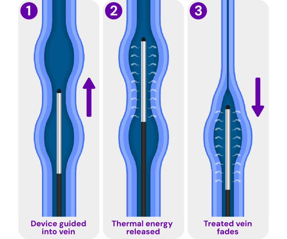 Medical illustration of radiofrequency ablation (RFA), showing a catheter delivering heat to close a diseased vein and restore healthy blood flow.
