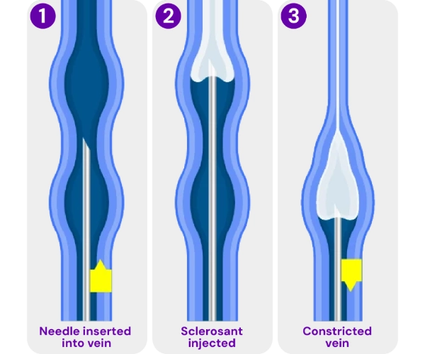 Medical illustration of sclerotherapy, showing a solution injected into a varicose or spider vein to close and treat the vein.