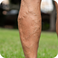 Visible spider veins or varicose veins photo