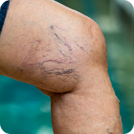 Spider Veins photo