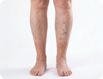 Visible spider veins photo