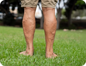 Visible varicose veins photo