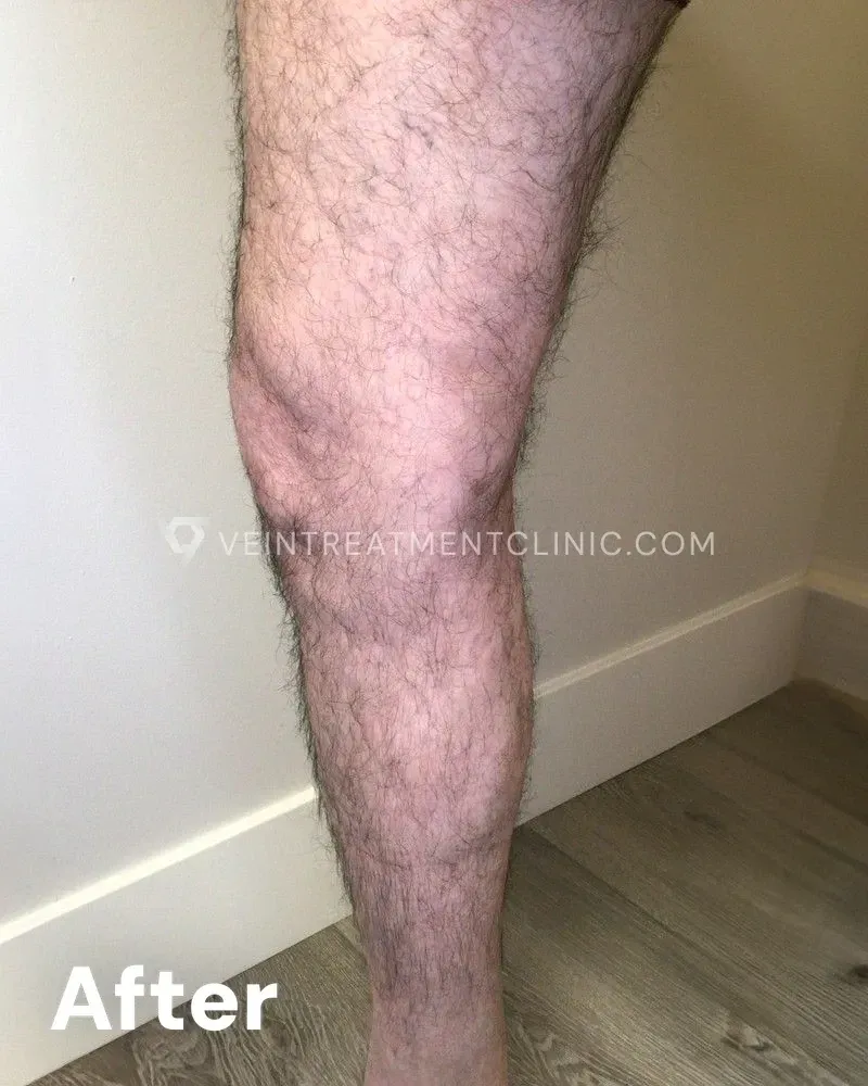 Varicose Veins — Calves, Knees & Thighs after