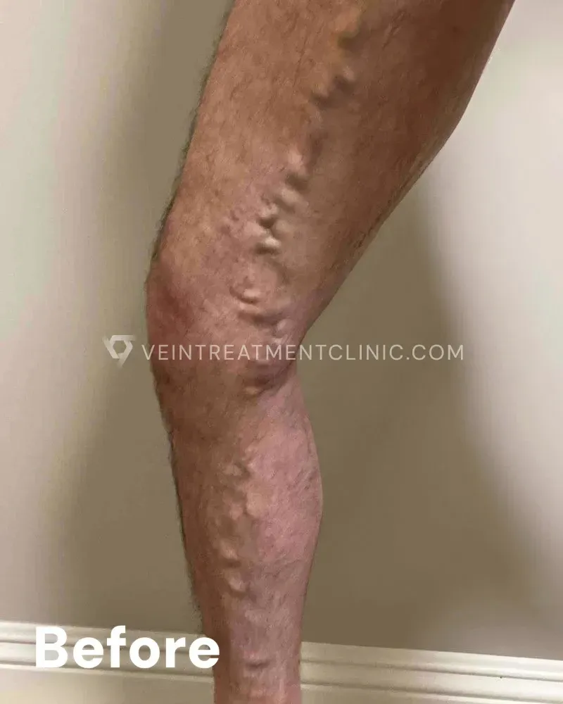 Varicose Veins — Calves, Knees & Thighs before