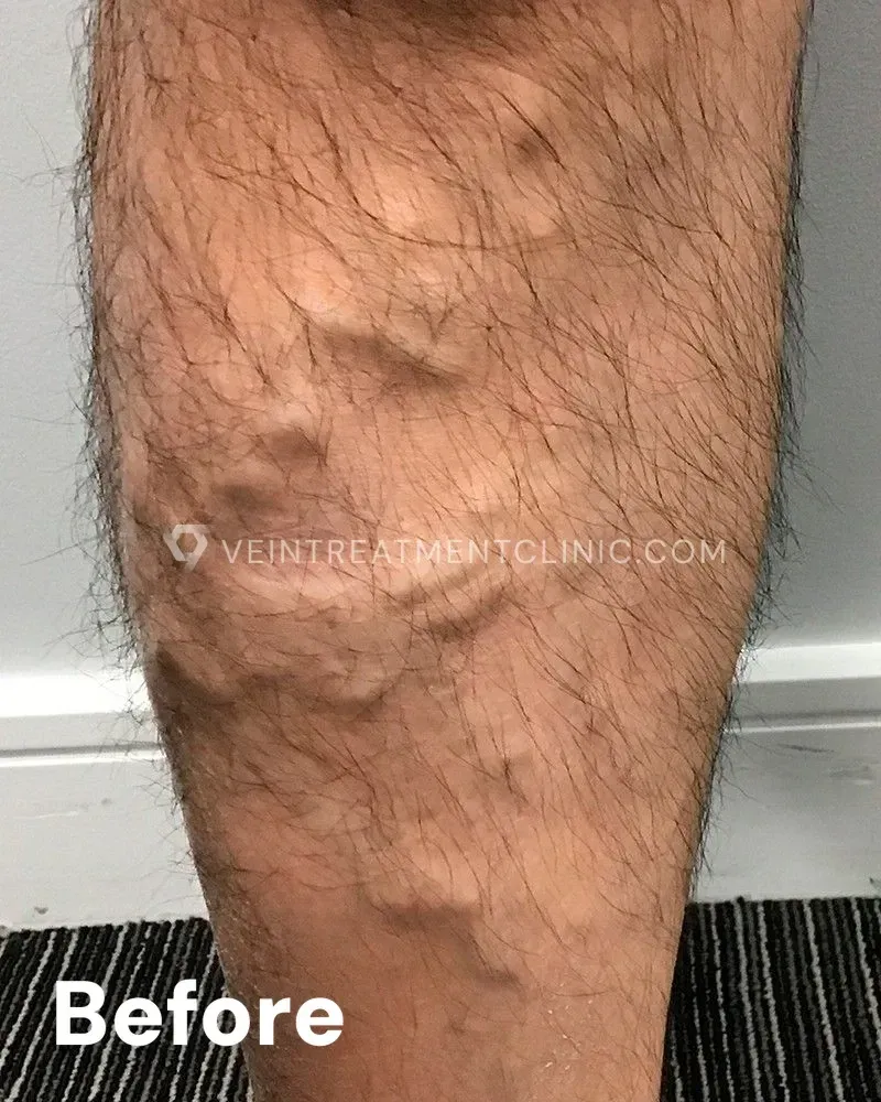Varicose Veins — Calves before